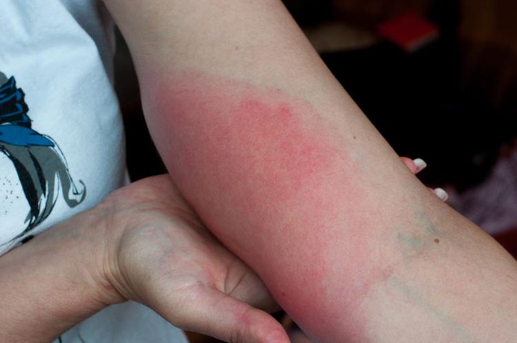 Wasp sting. Red swollen arm closeup. Skin allergy, tebuan