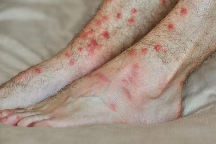 gnat bites can be painful and very itchy, and can sometimes swell up