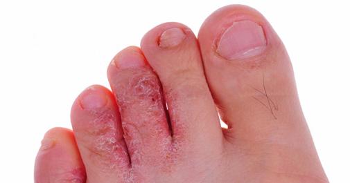 โรคน้ำกัดเท้า” เป็นอย่างไร เกิดจากอะไร รักษาอย่างไร ป้องกันอย่างไร  โดยหาหมอ.Com | Thinkofliving.Com